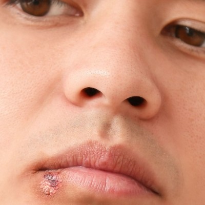 Education for Scar, Stretch Marks & Cold Sores | Mederma®