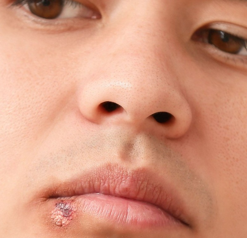 Education for Scar, Stretch Marks & Cold Sores | Mederma®