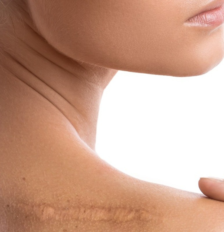 Education for Scar, Stretch Marks & Cold Sores Mederma®