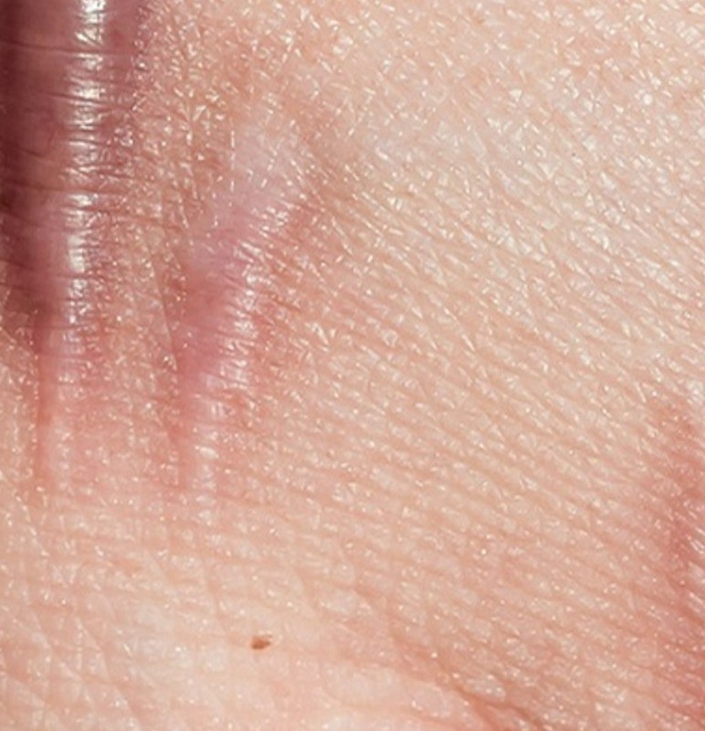 Education for Scar, Stretch Marks & Cold Sores | Mederma®